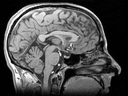 مولکول های پروتئین هانتینگتین با گلوتامین های زیاد نمی توانند به درستی تشکیل شوند؛ بنابراین می توانند توده های سمی ایجاد کنند که نشان داده شده است در طول زمان در مغز بیمار تجمع می یابند؛ با این حال این توده ها در اکثر انواع اسکن مغز مانند MRI قابل مشاهده نیستند.  